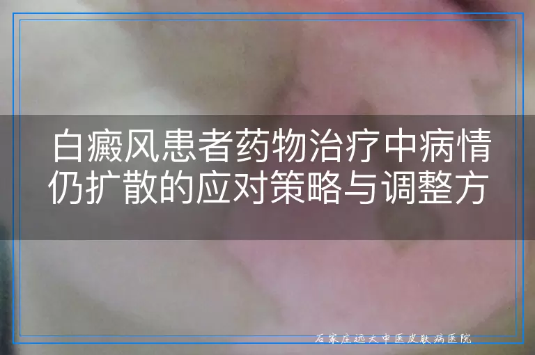 白癜风患者药物治疗中病情仍扩散的应对策略与调整方向