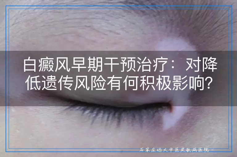 白癜风早期干预治疗：对降低遗传风险有何积极影响？