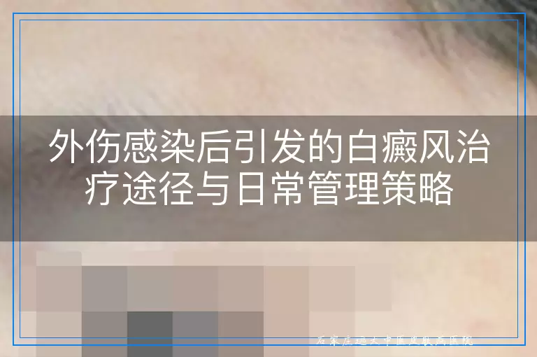 外伤感染后引发的白癜风治疗途径与日常管理策略