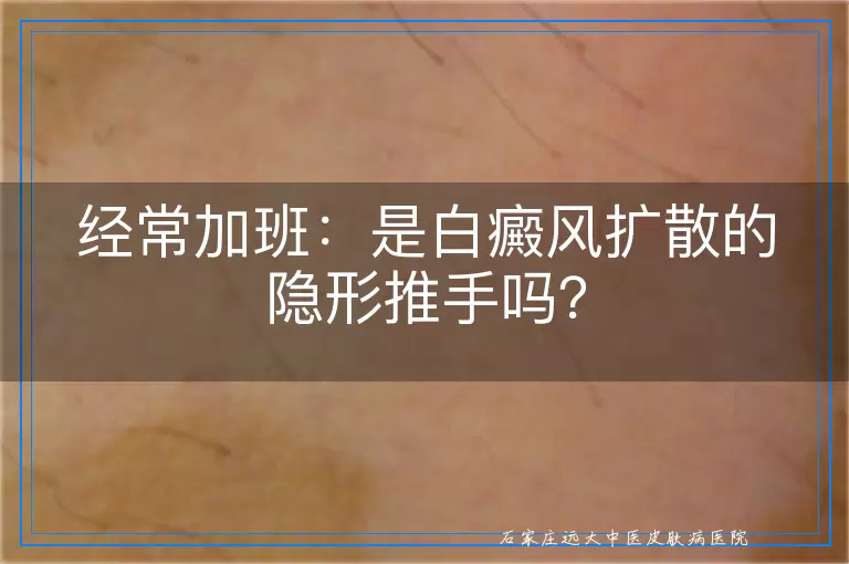 经常加班：是白癜风扩散的隐形推手吗？
