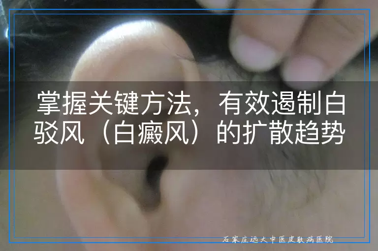 掌握关键方法，有效遏制白驳风（白癜风）的扩散趋势