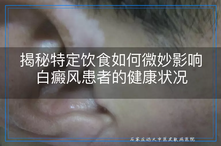揭秘特定饮食如何微妙影响白癜风患者的健康状况