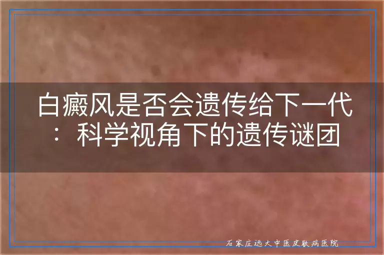 白癜风是否会遗传给下一代：科学视角下的遗传谜团