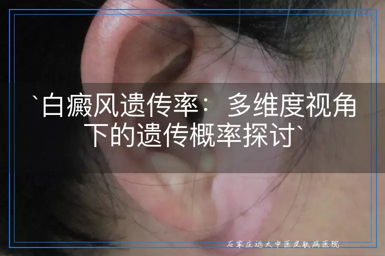白癜风遗传率：多维度视角下的遗传概率探讨