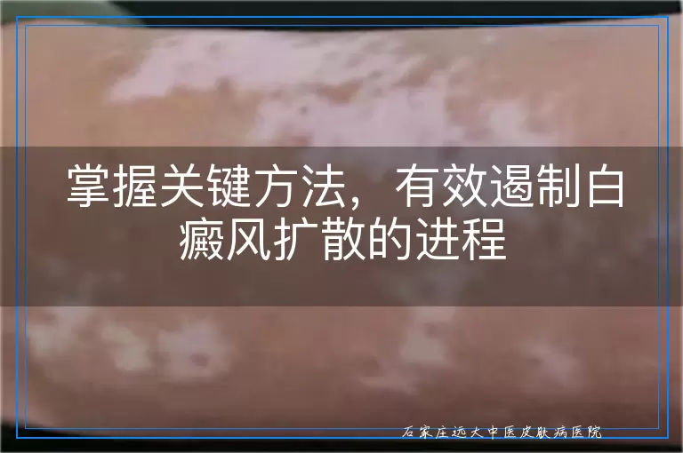 掌握关键方法，有效遏制白癜风扩散的进程