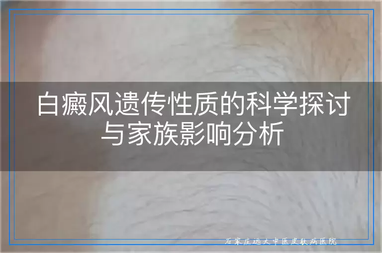 白癜风遗传性质的科学探讨与家族影响分析