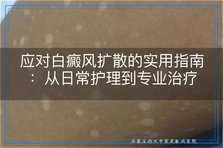 应对白癜风扩散的实用指南：从日常护理到专业治疗