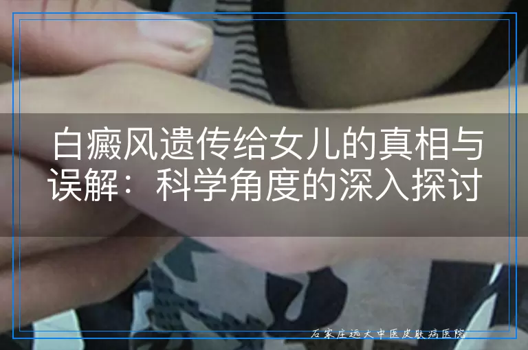 白癜风遗传给女儿的真相与误解：科学角度的深入探讨