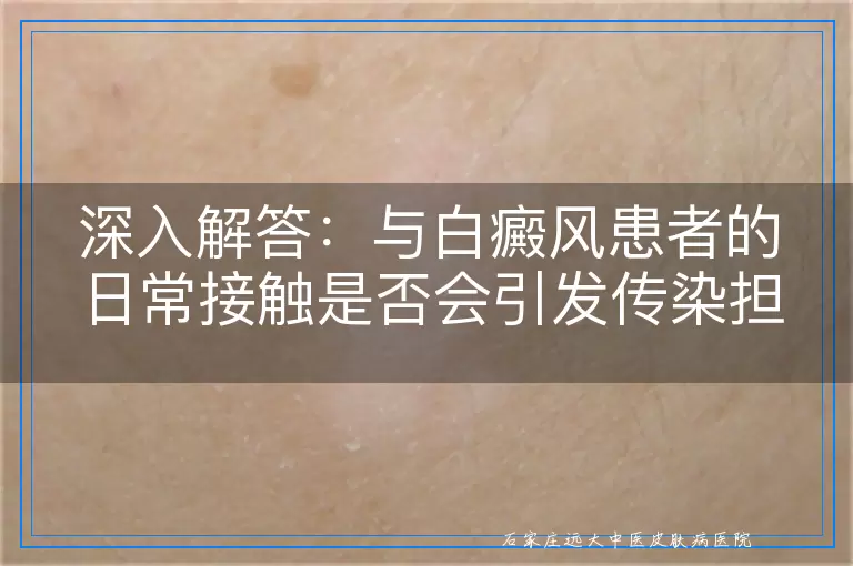 深入解答：与白癜风患者的日常接触是否会引发传染担忧？