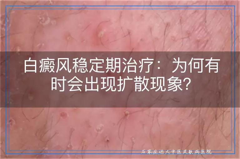 白癜风稳定期治疗：为何有时会出现扩散现象？