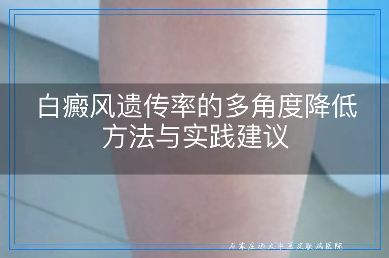 白癜风遗传率的多角度降低方法与实践建议