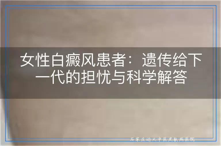 女性白癜风患者：遗传给下一代的担忧与科学解答