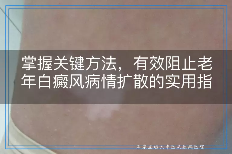 掌握关键方法，有效阻止老年白癜风病情扩散的实用指南