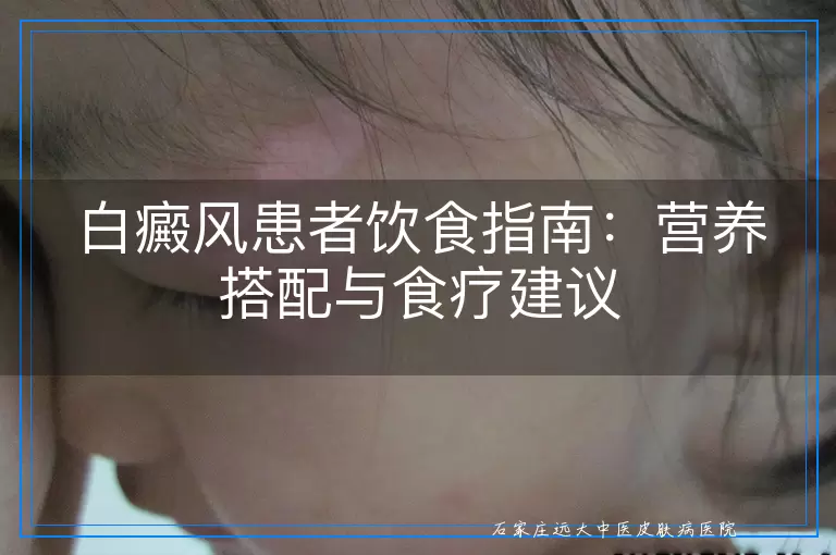 白癜风患者饮食指南：营养搭配与食疗建议