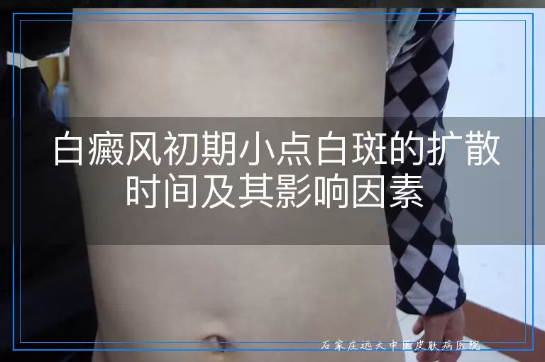 白癜风初期小点白斑的扩散时间及其影响因素