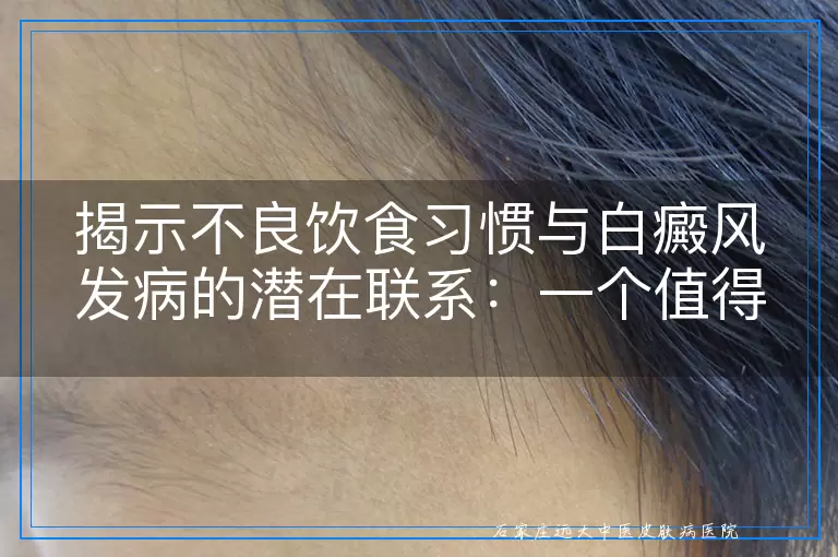 揭示不良饮食习惯与白癜风发病的潜在联系：一个值得关注的健康话题