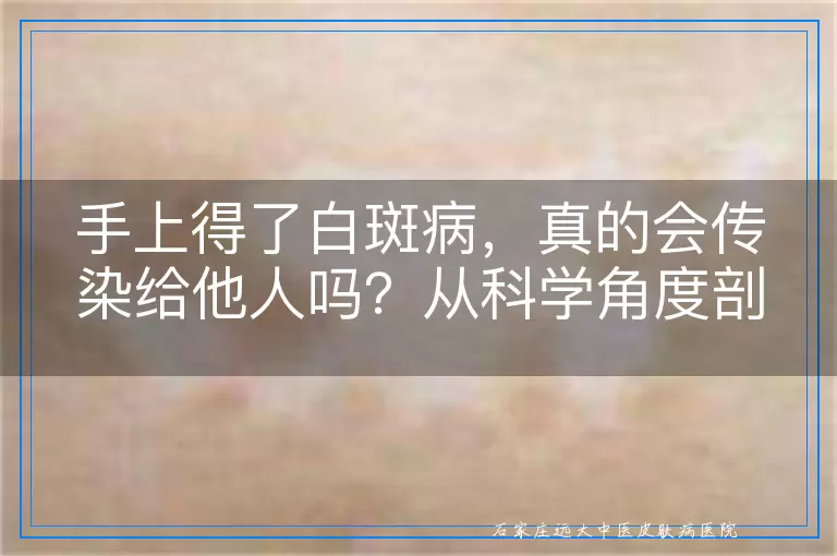 手上得了白斑病，真的会传染给他人吗？从科学角度剖析白斑病的传染性