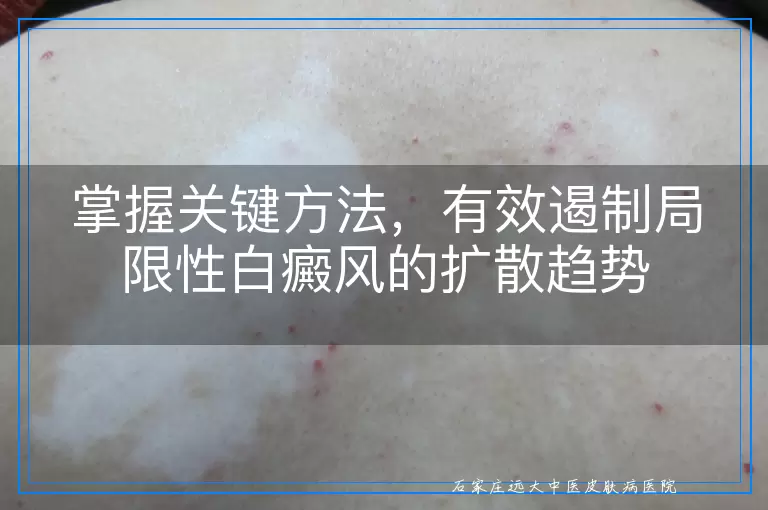 掌握关键方法，有效遏制局限性白癜风的扩散趋势