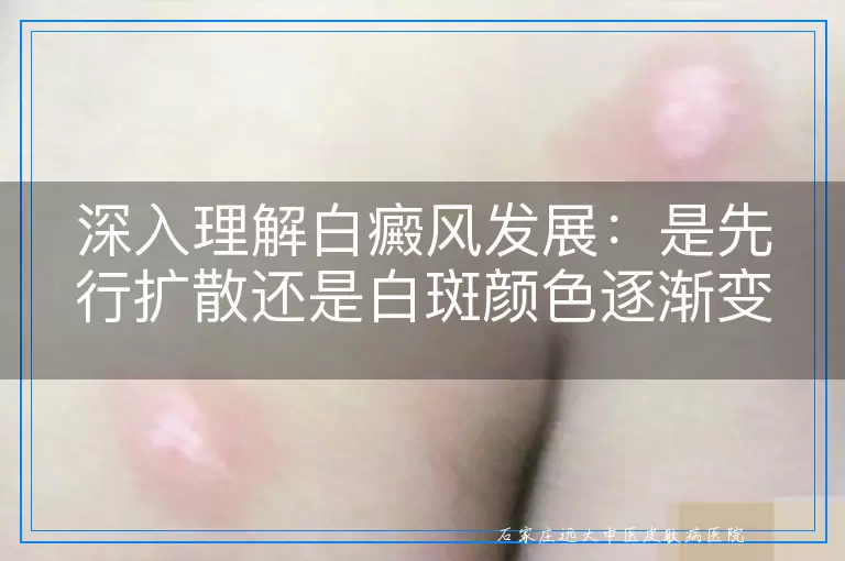 深入理解白癜风发展：是先行扩散还是白斑颜色逐渐变淡？
