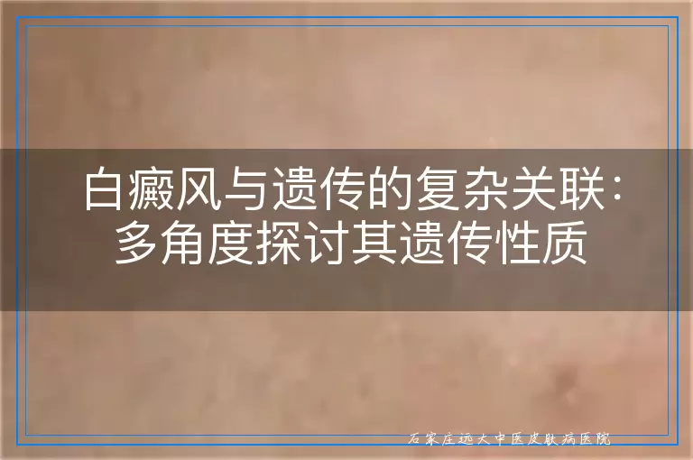 白癜风与遗传的复杂关联：多角度探讨其遗传性质
