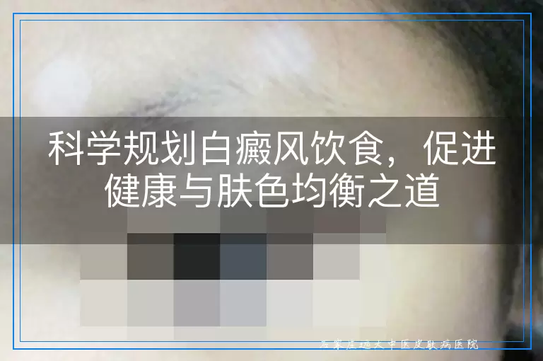 科学规划白癜风饮食，促进健康与肤色均衡之道