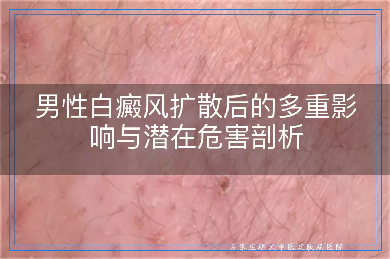 男性白癜风扩散后的多重影响与潜在危害剖析