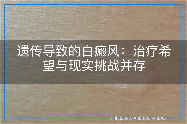 遗传导致的白癜风：治疗希望与现实挑战并存