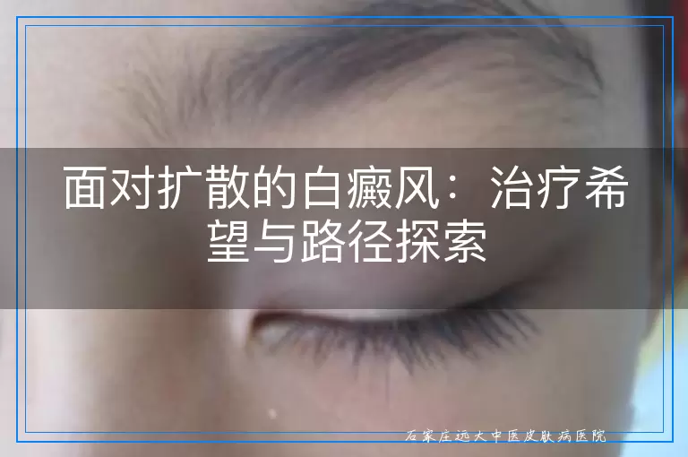 面对扩散的白癜风：治疗希望与路径探索
