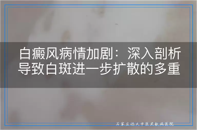 白癜风病情加剧：深入剖析导致白斑进一步扩散的多重因素
