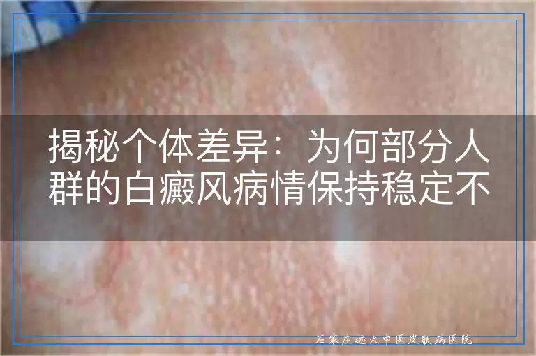 揭秘个体差异：为何部分人群的白癜风病情保持稳定不扩散
