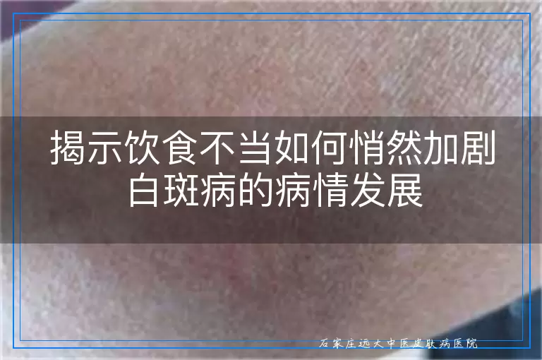 揭示饮食不当如何悄然加剧白斑病的病情发展