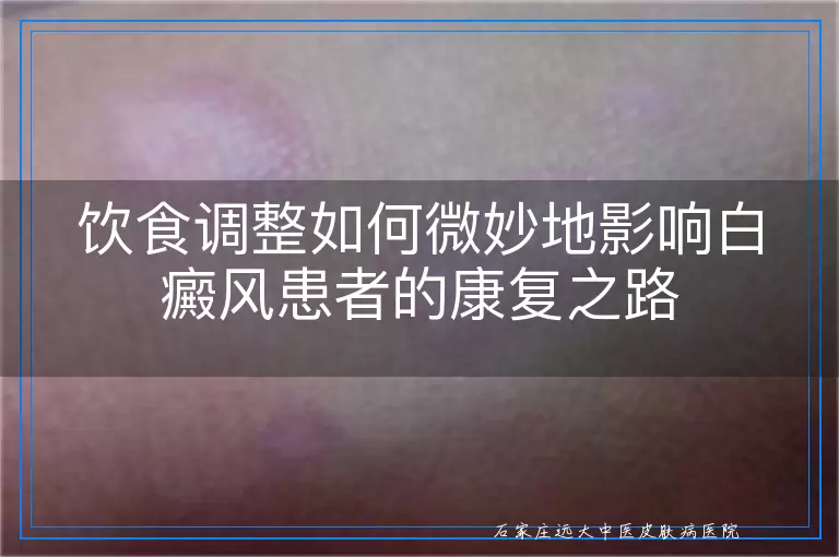 饮食调整如何微妙地影响白癜风患者的康复之路