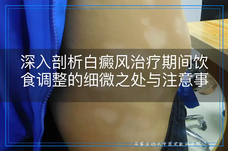 深入剖析白癜风治疗期间饮食调整的细微之处与注意事项