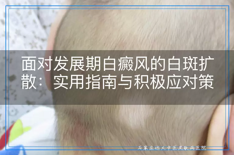 面对发展期白癜风的白斑扩散：实用指南与积极应对策略