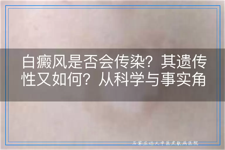 白癜风是否会传染？其遗传性又如何？从科学与事实角度深入剖析