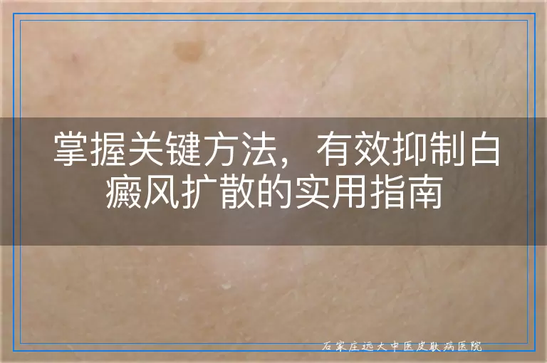 掌握关键方法，有效抑制白癜风扩散的实用指南