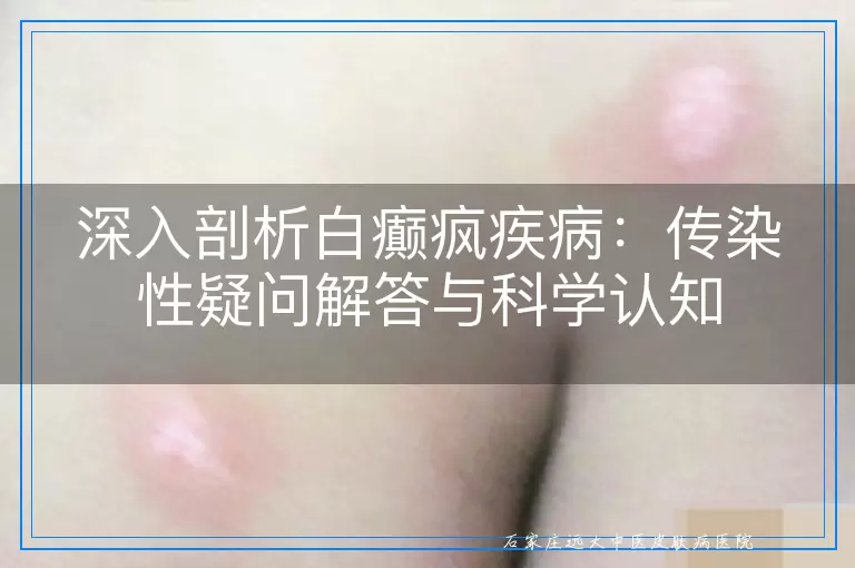 深入剖析白癫疯疾病：传染性疑问解答与科学认知