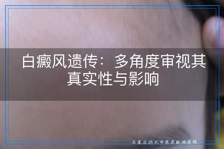 白癜风遗传：多角度审视其真实性与影响