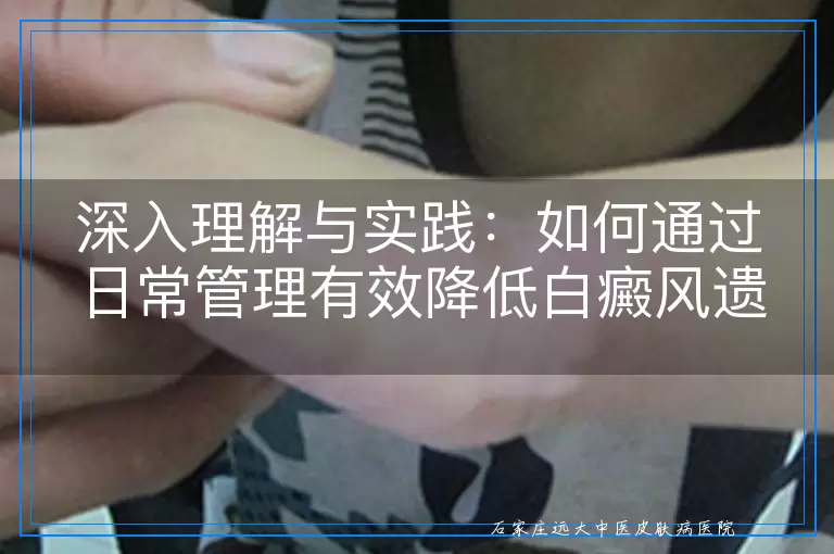 深入理解与实践：如何通过日常管理有效降低白癜风遗传风险
