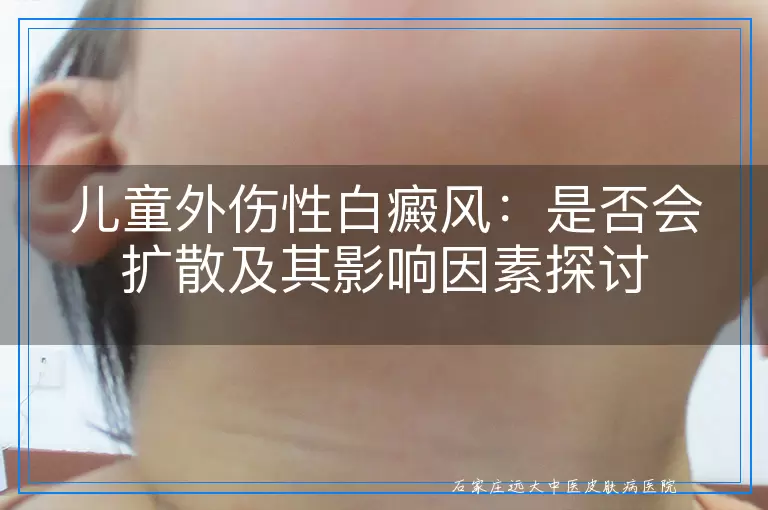 儿童外伤性白癜风：是否会扩散及其影响因素探讨