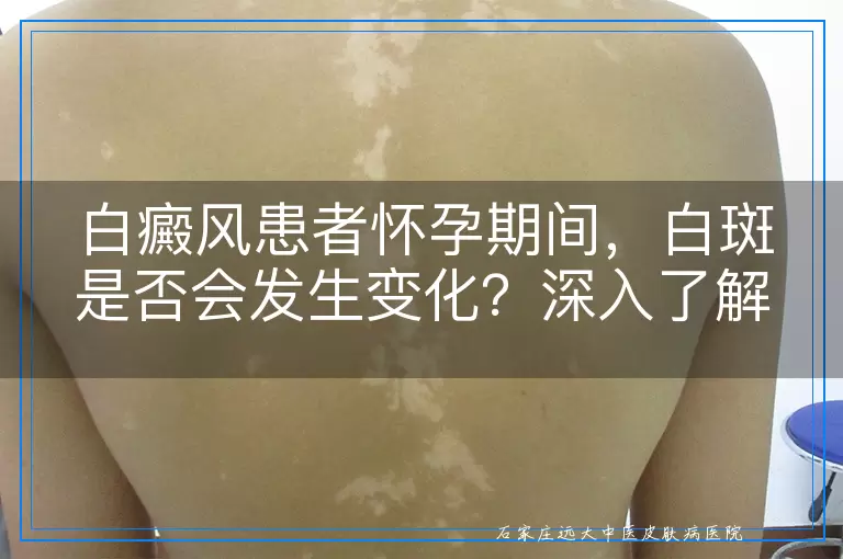白癜风患者怀孕期间，白斑是否会发生变化？深入了解孕期与白癜风的关系