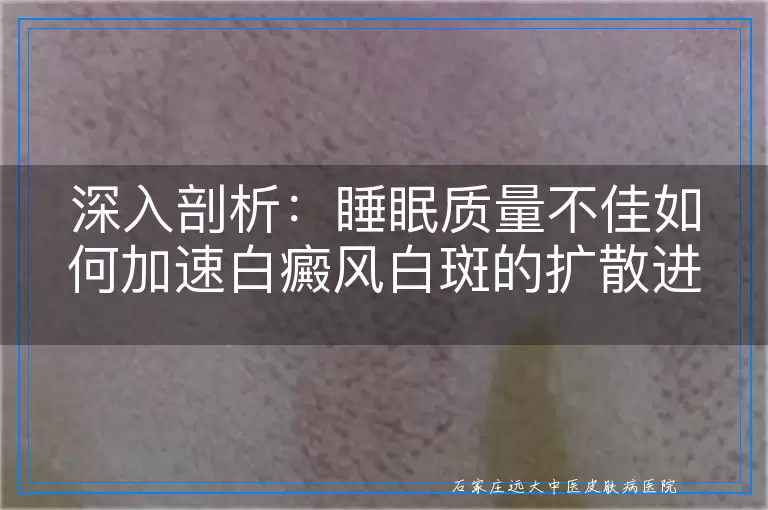 深入剖析：睡眠质量不佳如何加速白癜风白斑的扩散进程