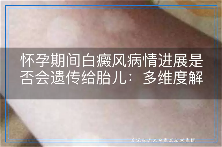 怀孕期间白癜风病情进展是否会遗传给胎儿：多维度解析与科学认知