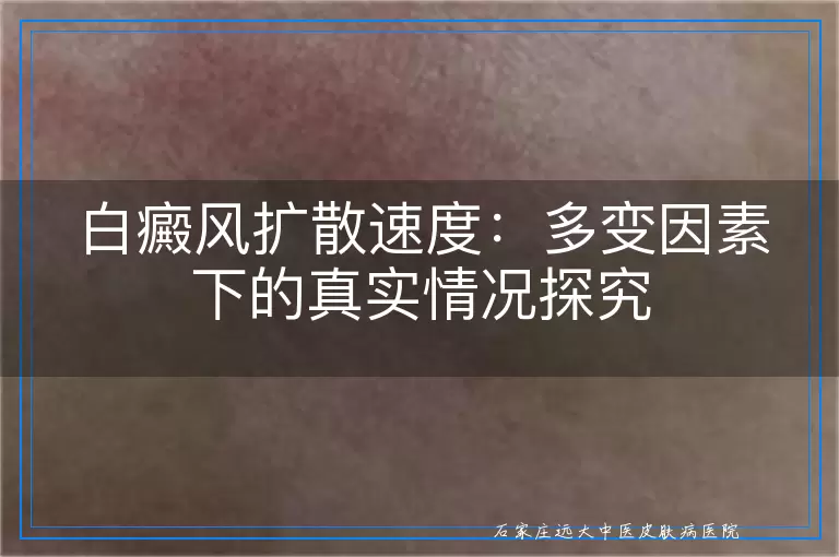白癜风扩散速度：多变因素下的真实情况探究