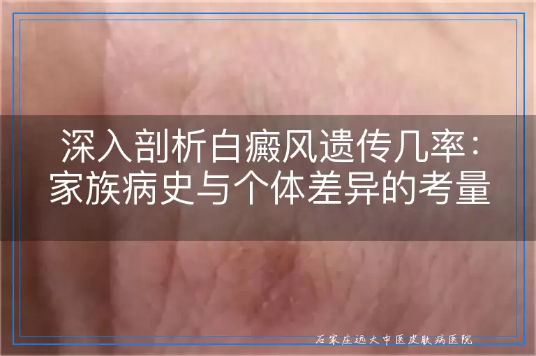 深入剖析白癜风遗传几率：家族病史与个体差异的考量