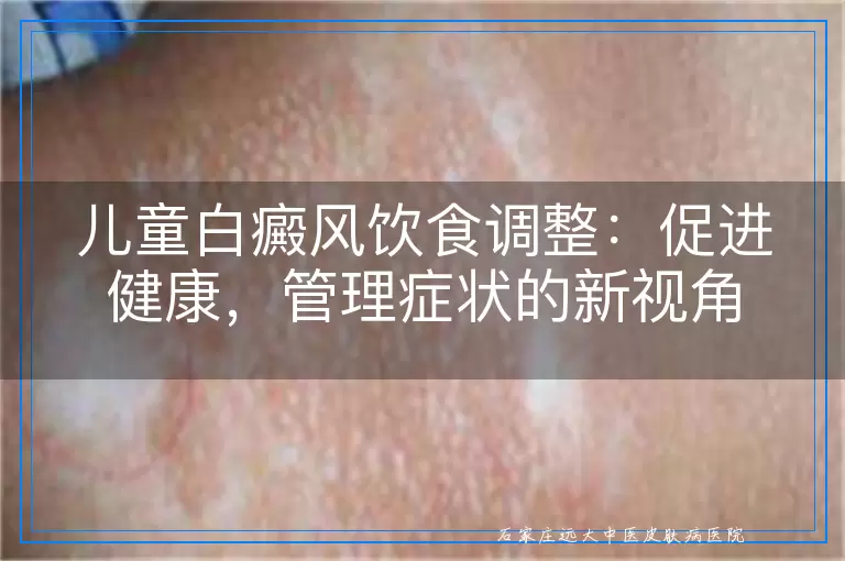 儿童白癜风饮食调整：促进健康，管理症状的新视角