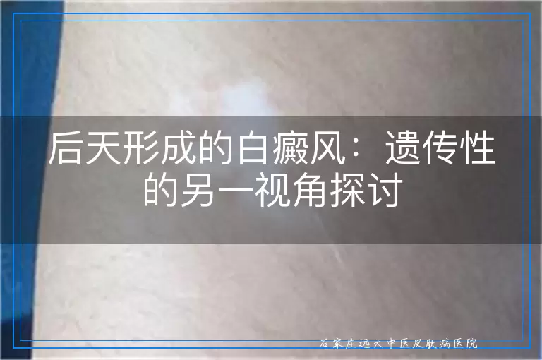后天形成的白癜风：遗传性的另一视角探讨
