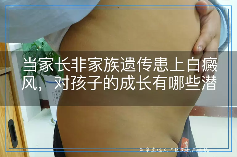 当家长非家族遗传患上白癜风，对孩子的成长有哪些潜在影响？