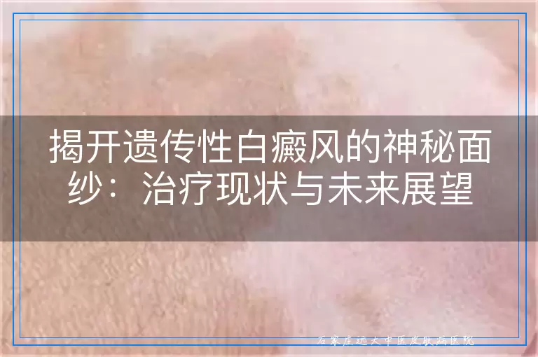 揭开遗传性白癜风的神秘面纱：治疗现状与未来展望