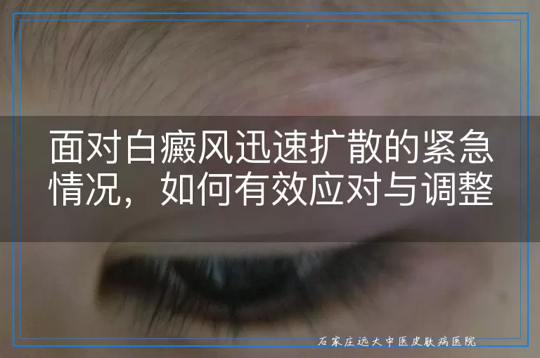 面对白癜风迅速扩散的紧急情况，如何有效应对与调整